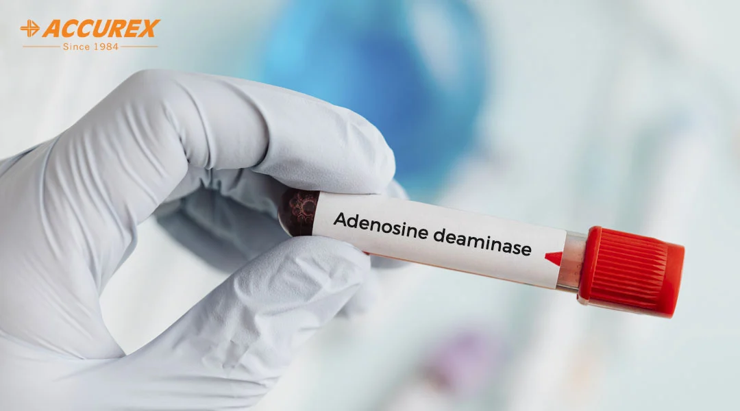 Adenosine Deaminase ADA Test Synthesis Tuberculosis